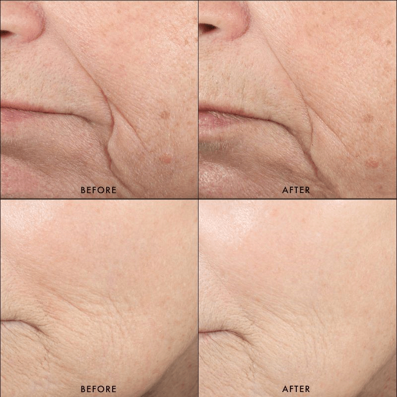SkinCeuticals Triple Lipid Restore before and after 
